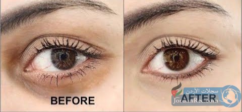 تعرف على أسباب تشكل الهالات السوداء حول العينين و طرق علاجها