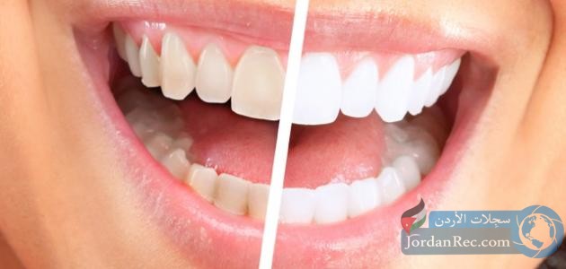 أفضل الطرق المنزلية الفعالة لتبييض الأسنان