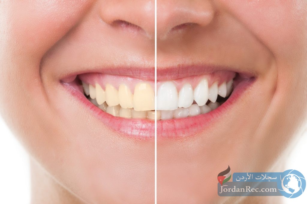 6 طرق طبيعية وفعالة لتبييض الأسنان