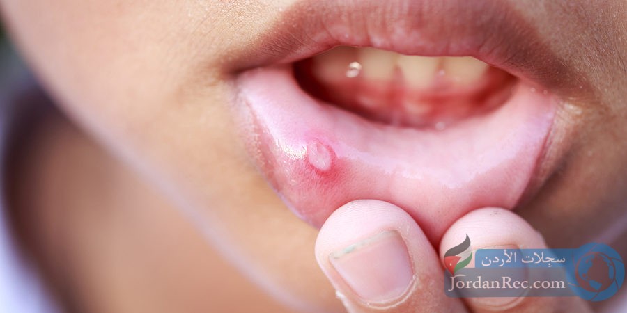 علاجات منزلية رائعة للتخلص من حمو الفم